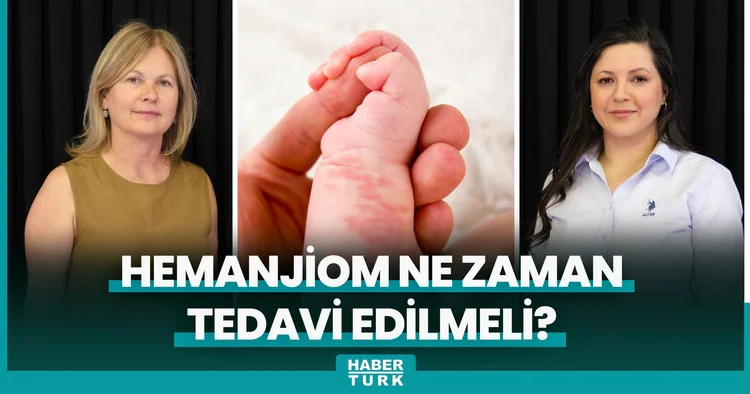 Hemanjiom ne zaman tedavi edilmeli?