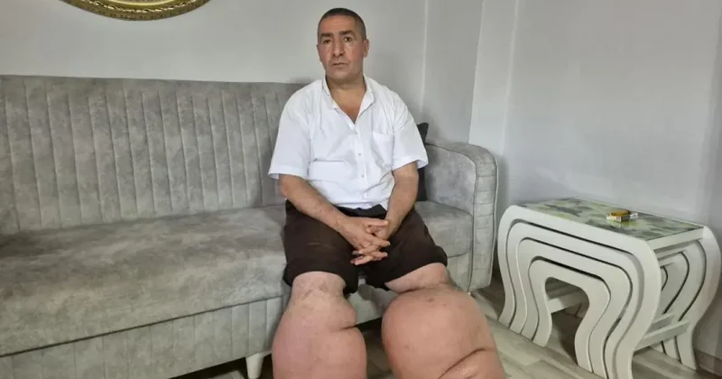 15 yıldır fil hastalığıyla mücadele ediyor