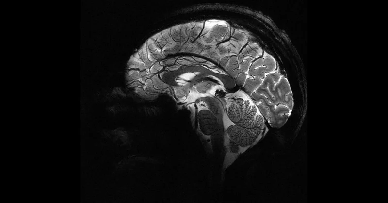 Yapay zeka, epilepsili çocuklarda doktorların gözden kaçırdığı gizli lezyonları buldu