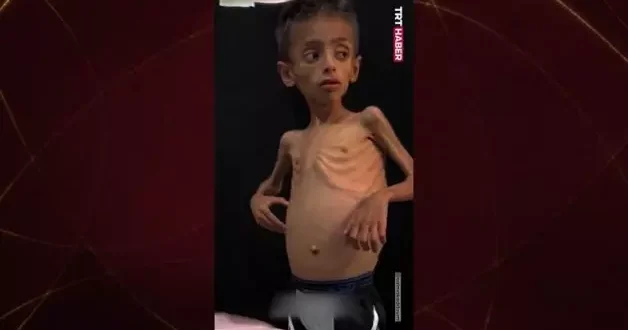 İsrail in uyguladığı aç bırakma politikası: Gazzeli çocuğun son hali!