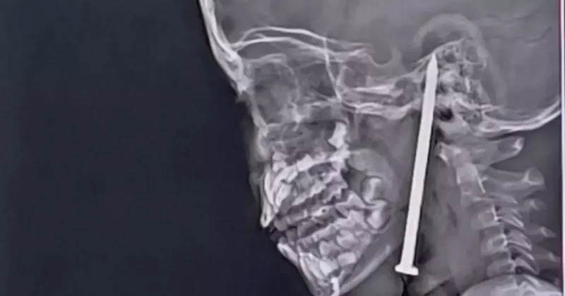 Beynine çivi saplanan küçük kız mucizevi şekilde kurtarıldı