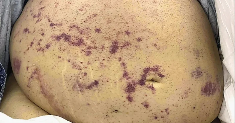 Böbrek nakli sonrası parazit şoku: İki hasta kurtçukla doldu Sözcü Gazetesi