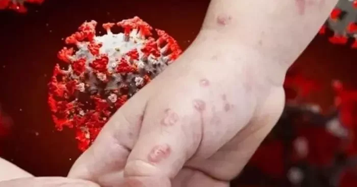 Çiçek virüsü alarmı! Hem insandan hem hayvandan bulaşıyor, hızla yayılıyor: Gana da vaka sayısı 133 e çıktı