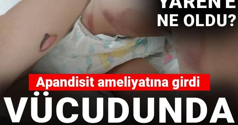 Apandisit ameliyatına girdi vücudunda yanık izleriyle çıktı! 3 yaşındaki Yaren e ne oldu?
