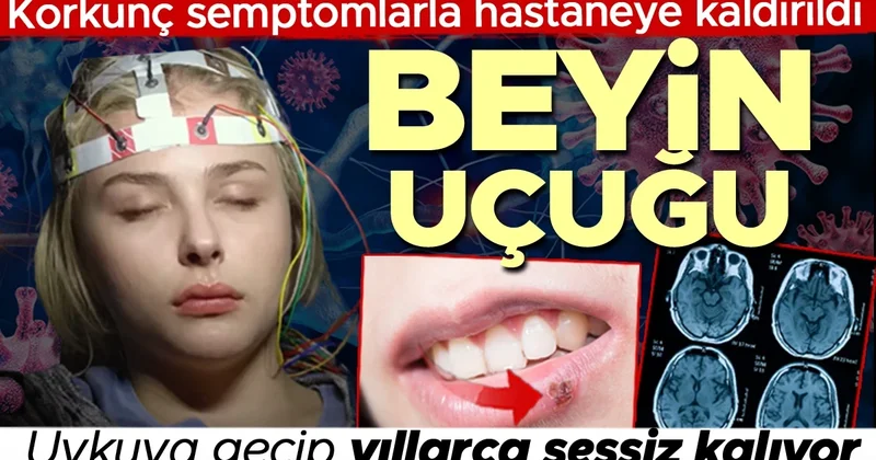 Beyinde uçuk mu olur? Uykuya geçip yıllarca sessiz kalabiliyor Her uçuk çıkaranda aynı risk var mı?