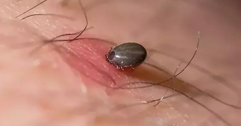 Kene ısırığı sonucu Kırım Kongo Kanamalı Ateşi ne yakalanan adam hayatını kaybetti