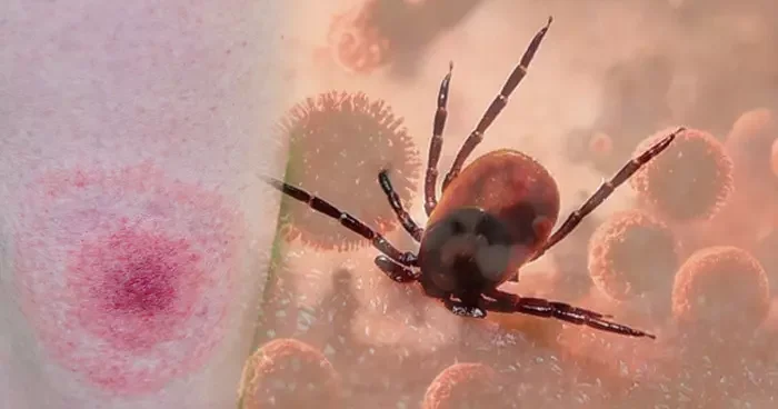 Kenelerden gelen tehlike: Lyme hastalığına yol açıyor: Bu belirtilere dikkat! Uzmanlar uyarıyor: Lyme hastalığı ölümcül seyredebilir
