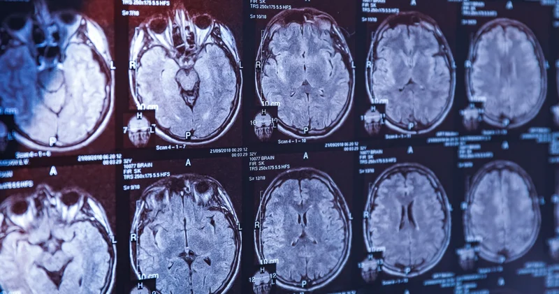 Alzheimer tanısında çığır açan gelişme Sağlık Haberleri
