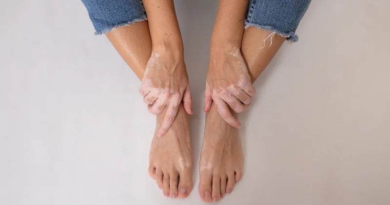Ciltte renk kaybı mı yaşıyorsunuz? Vitiligo hakkında bilmeniz gerekenler