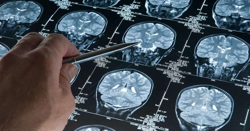 Alzheimer tarihe karışabilir! İşte yeni buluş