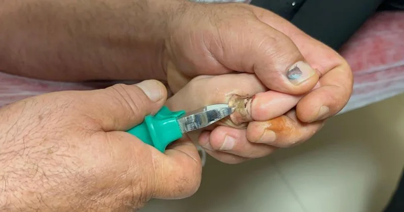 Çocuğun parmağına sıkışan metal cisim, kesilerek çıkarıldı