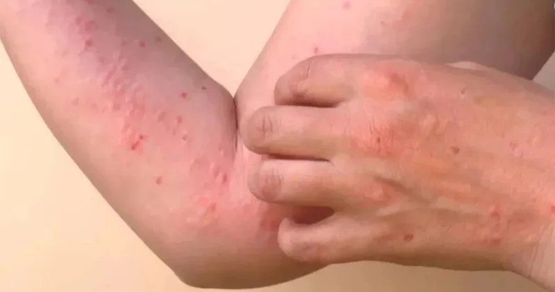 Türkiye kırmızı alarm listesinde, Chikungunya salgını