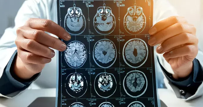 Harvard’dan çarpıcı yeni araştırma: Alzheimer tedavisine karşı yeni umut! Uzmanlar: Bu büyük bir dönüm noktası olabilir