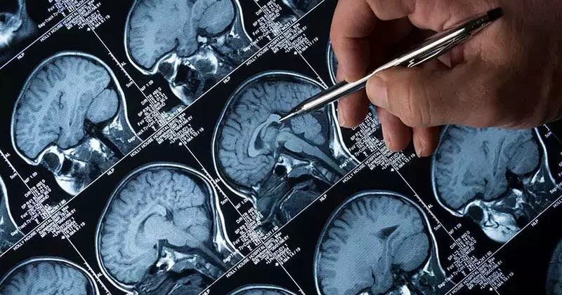 Alzheimer tedavisinde lityum umudu