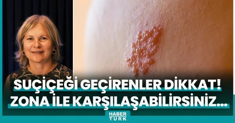 Küçükken suçiçeği geçirenler dikkat! Her an zona ile karşılaşabilirsiniz…