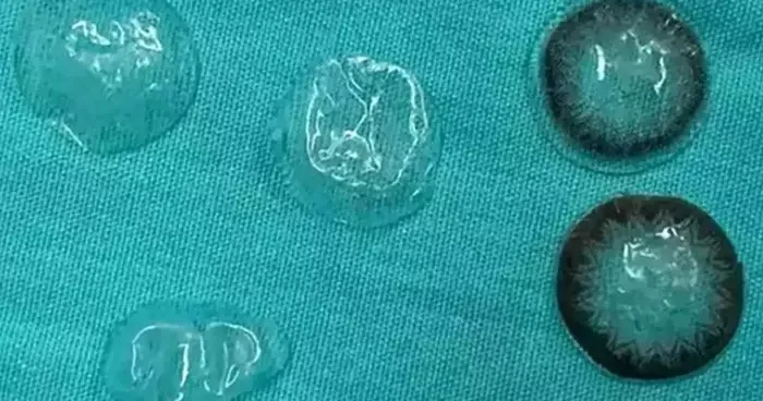 Doktorlar kadının gözünün arkasında kalan 5 kontakt lensi çıkarttı! Orada olduğunun farkında bile değildi