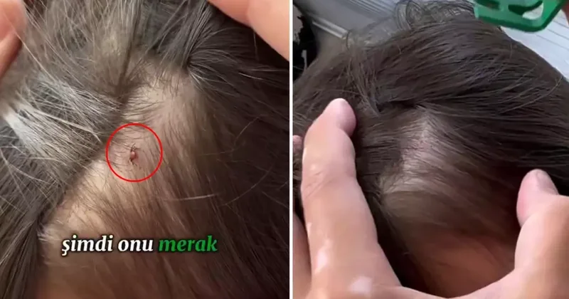 Baba, kızının kafasına yapışan keneyi böyle kopardı