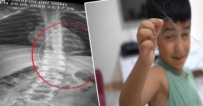 Salatalık parçası yuttu hastaneye gitti! Çekilen röntgenle ortaya çıktı! 18 santimetrelik kateterin unutulmuş