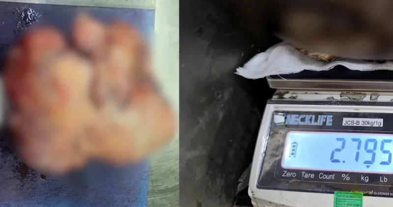 Nefes darlığı şikayeti ile hastaneye gitti, göğsünden tam 3 kilo çıkarıldı!