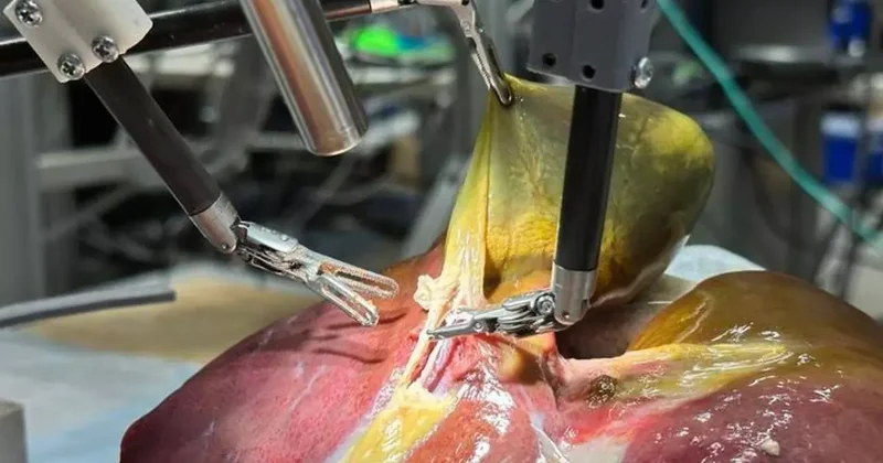 Ameliyatlar değişiyor! Tarihte ilk kez bir robot, yardım almadan gerçekleştirdi!