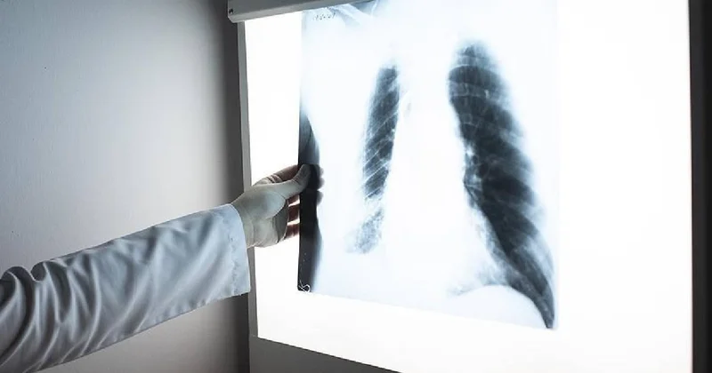 AstraZeneca, yapay zeka ile 5 milyon akciğer grafisinde kanser riski taraması yaptı