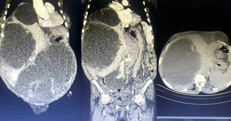 Tüm karnı kist kapladı! Doktorlar bile böyle bir şey görmedi