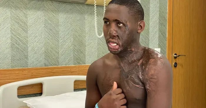 Acılı bekleyiş: Yüzü ve boynunda ağır yanıklar vardı! Ugandalı çoban, 10 yıl sonra Türkiye de tedavi edildi...