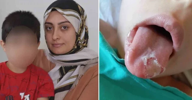 Nevşehir’de 5 yaşındaki çocuğun ameliyatta dili ve dudağı yandı Nevşehir Haberleri