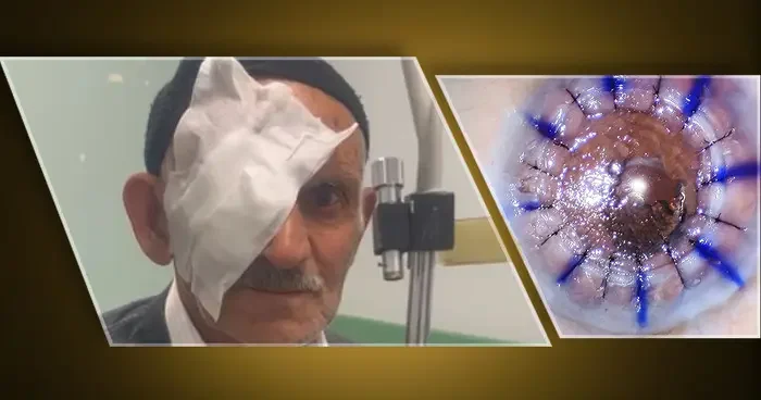Nakille gelen ışık... 10 yıldır kornea nakli bekleyen 83 yaşındaki hasta: Gözümü sen açtın