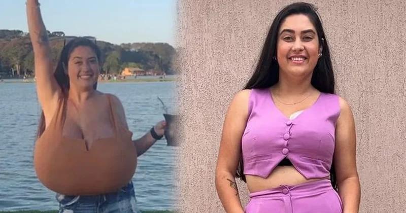 Sadece 300 kişide görülen hastalık: Göğüsleri aylar içinde 12 kiloya ulaştı Sözcü Gazetesi
