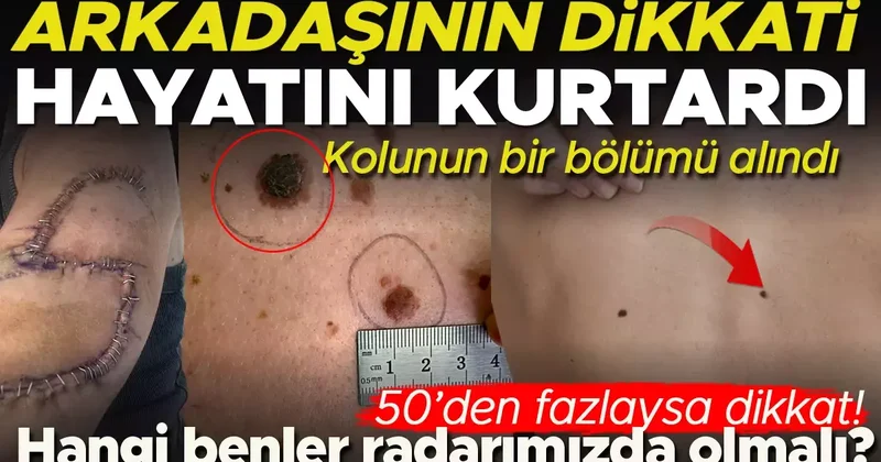 Arkadaşının dikkati sayesinde kanser olduğunu öğrendi, kolunun bir kısmı alındı Hangi benler radarımızda olmalı?