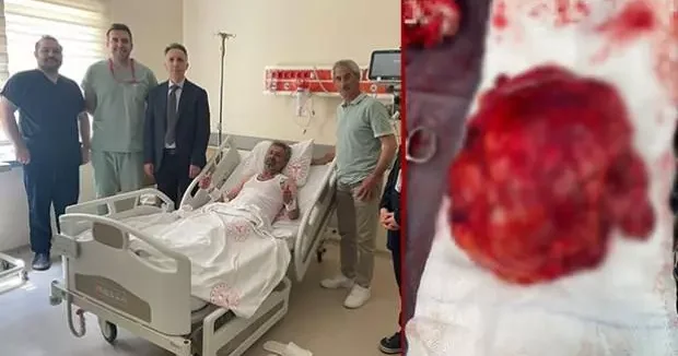 Sakarya haberleri 46 yaşındaki adamın böbreğinden çıktı, gören gözlerine inanamadı 17 Haziran 2025
