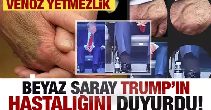 Beyaz Saray Trump ın hastalığını açıkladı: Venöz yetmezlik
