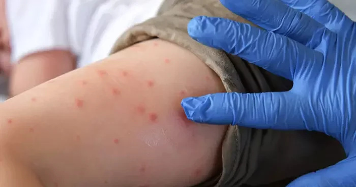 Yeni küresel salgın uyarısı: Chikungunya virüsü Türkiye de var mı? Uzman isim açıkladı: Aedes türüne ait sivrisinek İstanbul da görüldü