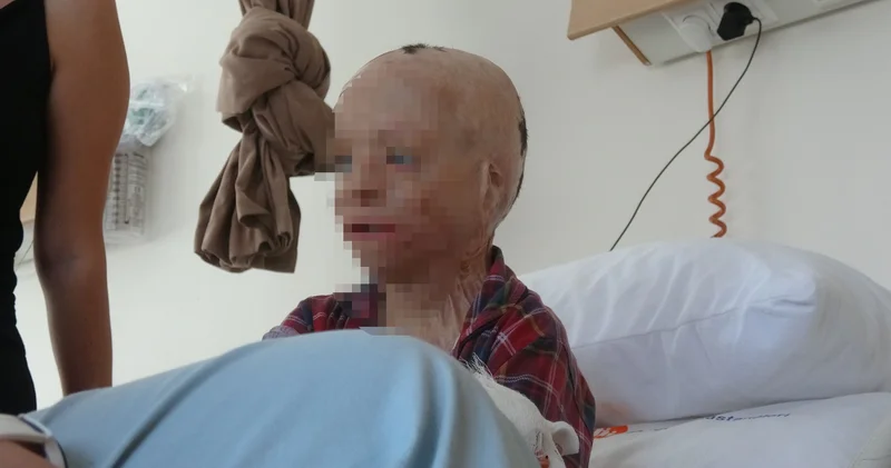 Korkunç yangında babasız, kardeşsiz kaldı: 50 den fazla ameliyat oldu