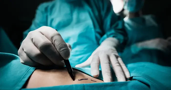 Yaz öncesi estetikte zirvede: Fazla yağlara veda zamanı! Liposuction kimlere yapılmaz? Uzmanlar uyarıyor: Havalar çok ısınmadan yaptırılmalı
