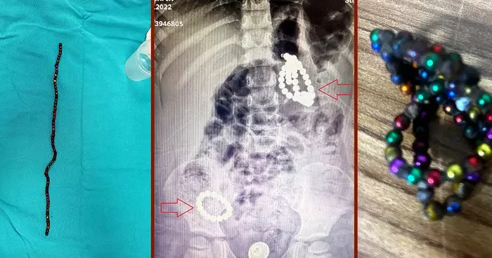 Bu oyuncak bir ölüm tuzağı! Herkesi çok şaşırtan vaka: 3 yaşında, karnında 66 adet mıknatısla aylarca yaşamış! Tehlikeye karşı uyarı: İç organlarını deliyor
