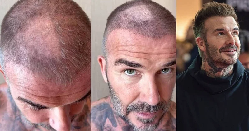 David Beckham ın tıraş kazası magazin haberleri