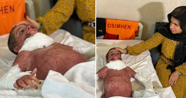 Mangal yaparken tutuşturucu jel parladı Mustafa nın vücudunun yarısı yandı: Yapay deri nakliyle hayata tutundu Aktüel Haberleri
