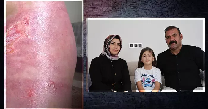 Düğünde korkunç olay! Üzerine dökülen sıvıyla hayatı karardı: Yanıyorum diyerek yanıma gelince...