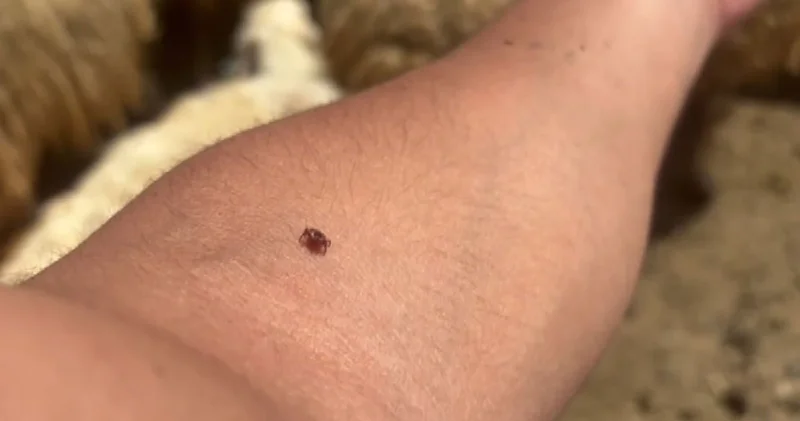 Kene tutundukça, hastalık riski artıyor: Gerekirse kendiniz çıkarın