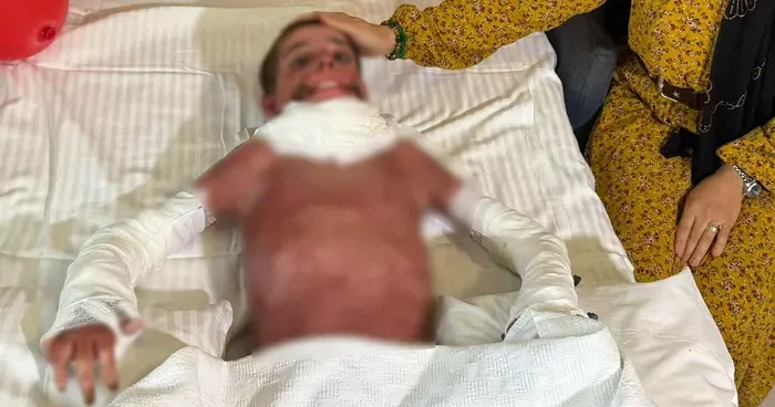Mangal yaparken vücudunun yüzde 50 si yandı! 11 yaşındaki Mustafa ya yapay deri nakli yapıldı...