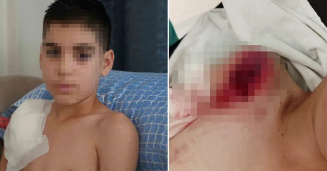Samsun da sahipli köpek 11 yaşındaki çocuğu sırtından omzundan ve kalçasındanı ısırdı: Sağ kolu felç kaldı Aktüel Haberleri