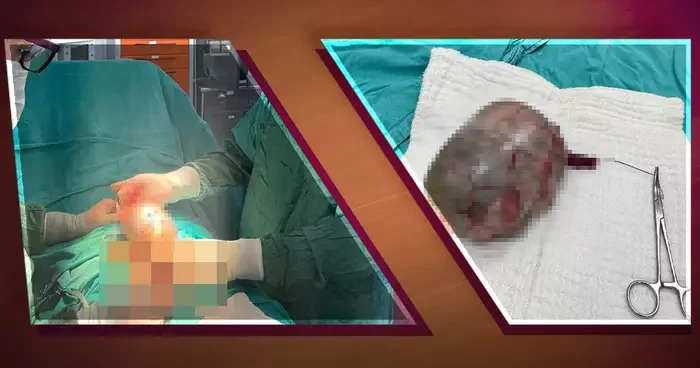 Testisten 20 santimetrelik dev tümör çıkarıldı! Uzmanlar: Hasta şikayetini gizlemiş, kitle karna ve organlara yayılmış