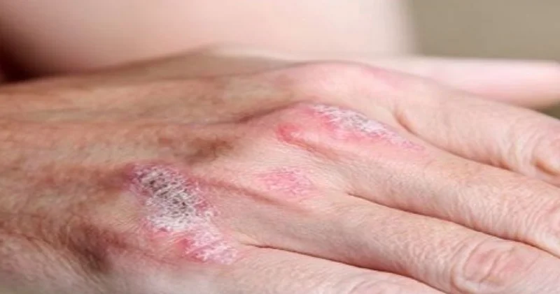 Romatoloji Uzmanı uyarıyor: Sedef romatizmasında erken tanı eklem hasarını önlüyor