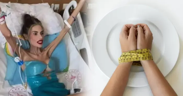 Aç kalma hastalığı değil, ölümcül bir psikolojik rahatsızlık! Anoreksiya nevroza nedir? Anoreksiya nasıl tedavi edilir?