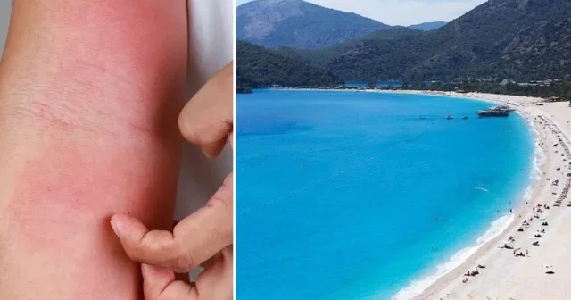 Antalya da deniz suyu ısındı kaşıntılar arttı: Denizdeki organizmalar artınca şikayetler başladı Aktüel Haberleri