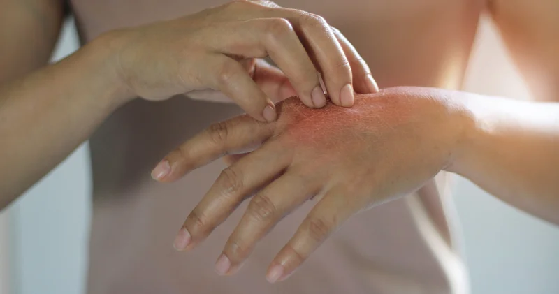 Ellerde kaşıntı ve kuruluk giderek artıyor mu? El egzaması hakkında bilmeniz gerekenler