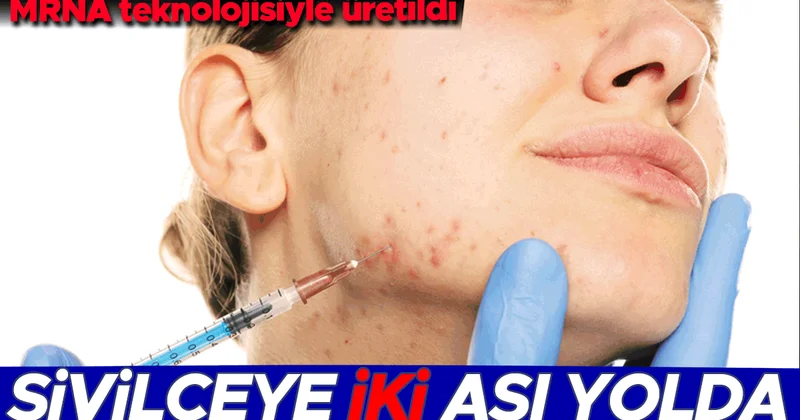 Sivilceye karşı iki aşı yolda