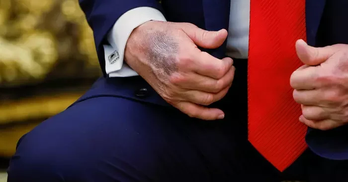 O ziyaret sırasında dikkat çekti! ABD Başkanı Trump ın elindeki morluk gündem oldu: Beyaz Saray dan açıklama geldi